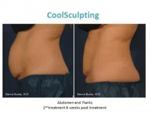 coolsculpting, san diego, ca