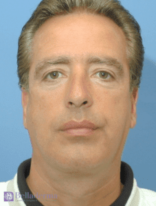 Belladerma Mini Facelift™ Before and After Pictures in San Diego, CA