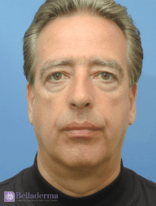 Belladerma Mini Facelift™ Before and After Pictures in San Diego, CA