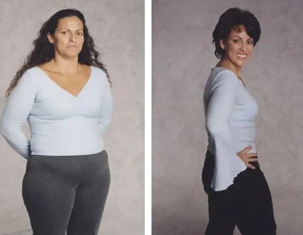 Mommy Makeover Before and After Pictures San Diego, CA