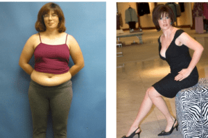 Mommy Makeover Before and After Pictures in San Diego, CA