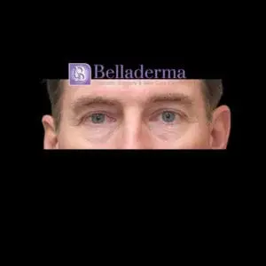 Lower Blepharoplasty Before and After Pictures San Diego, CA