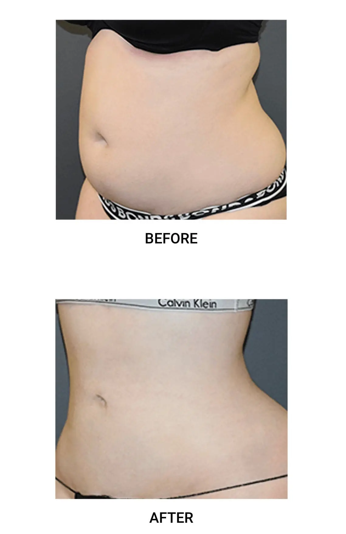 vaser lipo after c section Liposuction Birmingham Lipo VASER + Laser, Before