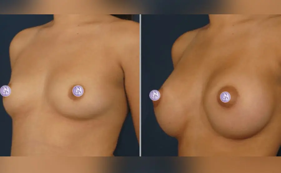 Breast-Aug Breast Augmentation Before and After Pictures San Diego, CA