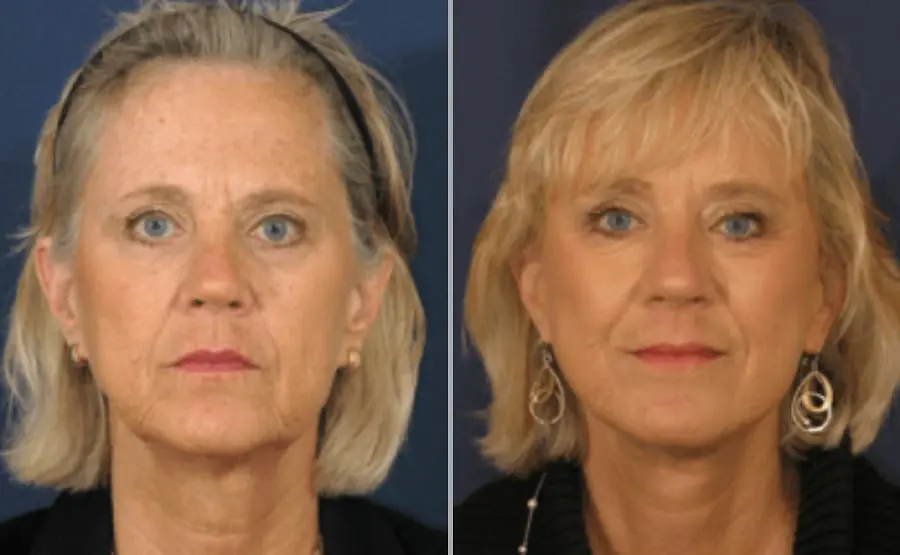 Facelift Facelift Before and After Pictures San Diego, CA