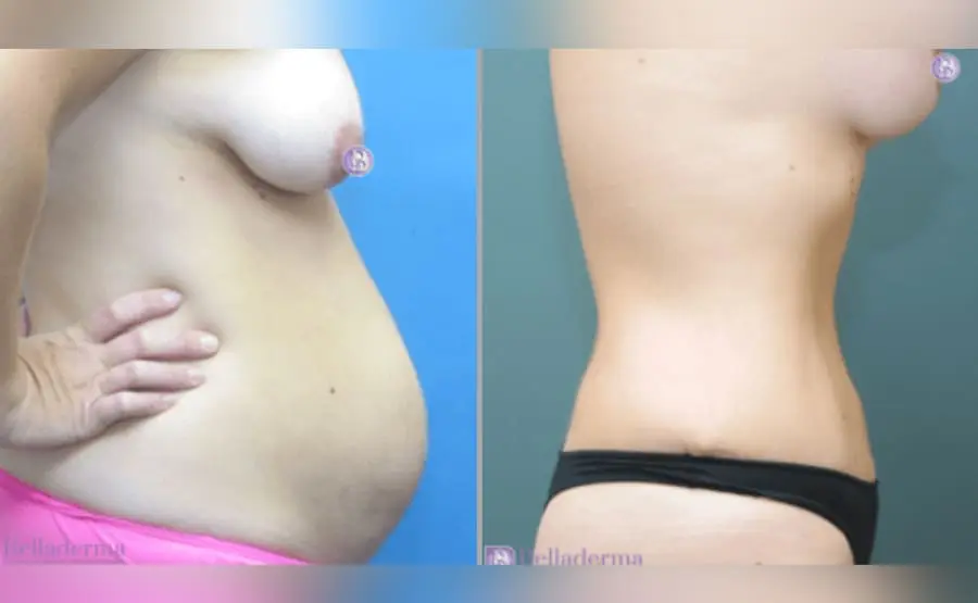 Mommy-makeover Mommy Makeover Before and After Pictures San Diego, CA