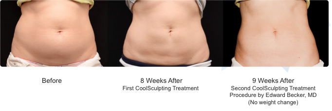 coolsculpting, san diego, ca