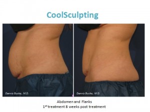 coolsculpting, san diego, ca