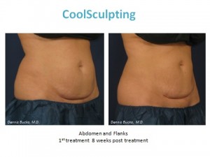 coolsculpting, san diego, ca