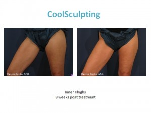 coolsculpting, san diego, ca