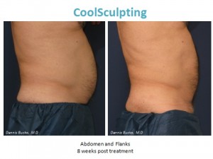 coolsculpting, san diego, ca