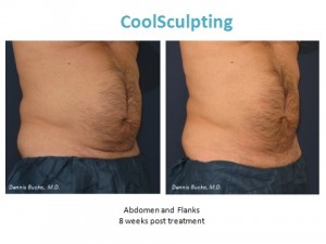 coolsculpting, san diego, ca