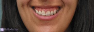 Gummy Smile Before and After Pictures in San Diego, CA