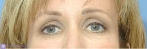 Brow Lift Before and After Pictures in San Diego, CA