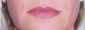 Lip Augmentation Before and After Pictures in San Diego, CA