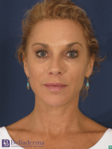 Belladerma Mini Facelift™ Before and After Pictures in San Diego, CA