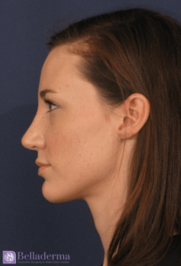 Rhinoplasty Before and After Pictures in San Diego, CA