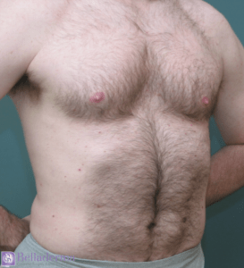 Liposuction Before and After Pictures in San Diego, CA