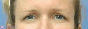 Brow Lift Before and After Pictures in San Diego, CA