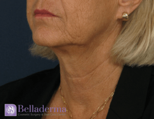 Neck Lift Before and After Pictures in San Diego, CA