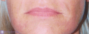 Lip Augmentation Before and After Pictures in San Diego, CA