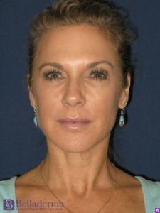 Belladerma Mini Facelift™ Before and After Pictures in San Diego, CA