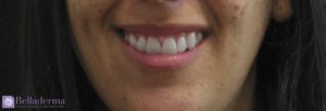 Gummy Smile Before and After Pictures in San Diego, CA