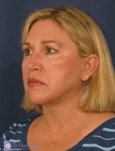Belladerma Mini Facelift™ Before and After Pictures in San Diego, CA