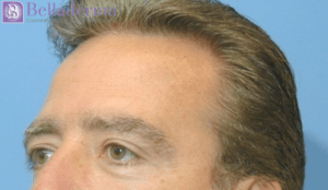 Brow Lift Before and After Pictures in San Diego, CA
