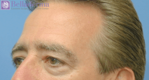 Brow Lift Before and After Pictures in San Diego, CA