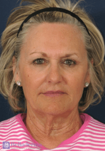 Belladerma Mini Facelift™ Before and After Pictures in San Diego, CA