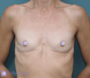 Breast Augmentation Before and After Pictures in San Diego, CA