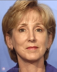 Belladerma Mini Facelift™ Before and After Pictures in San Diego, CA