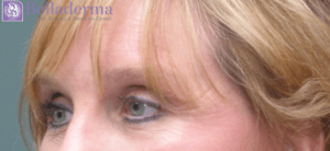 Brow Lift Before and After Pictures in San Diego, CA