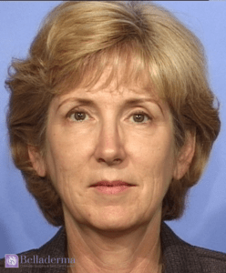Belladerma Mini Facelift™ Before and After Pictures in San Diego, CA