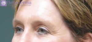 Brow Lift Before and After Pictures in San Diego, CA