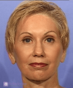 Belladerma Mini Facelift™ Before and After Pictures in San Diego, CA