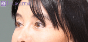 Brow Lift Before and After Pictures in San Diego, CA