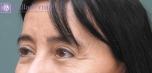Brow Lift Before and After Pictures in San Diego, CA