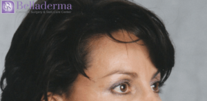 Brow Lift Before and After Pictures in San Diego, CA