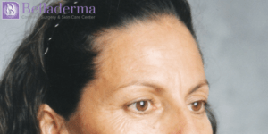 Brow Lift Before and After Pictures in San Diego, CA