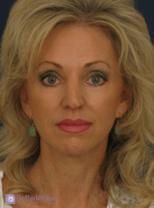 Belladerma Mini Facelift™ Before and After Pictures in San Diego, CA