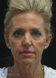 Belladerma Mini Facelift™ Before and After Pictures in San Diego, CA