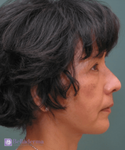 Belladerma Mini Facelift™ Before and After Pictures in San Diego, CA