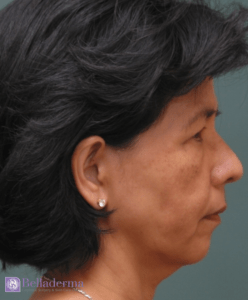 Belladerma Mini Facelift™ Before and After Pictures in San Diego, CA