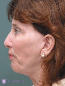 Belladerma Mini Facelift™ Before and After Pictures in San Diego, CA