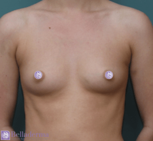 Breast Augmentation Before and After Pictures in San Diego, CA