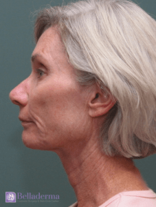 Belladerma Mini Facelift™ Before and After Pictures in San Diego, CA