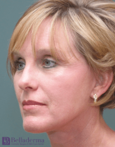 Belladerma Mini Facelift™ Before and After Pictures in San Diego, CA
