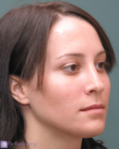 Rhinoplasty Before and After Pictures in San Diego, CA